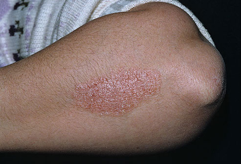 Over three percent of Pakistan's population suffering from Psoriasis: Expert