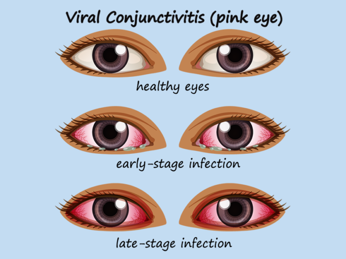 Pink Eye Infection Symptoms and Treatment - Pakistan