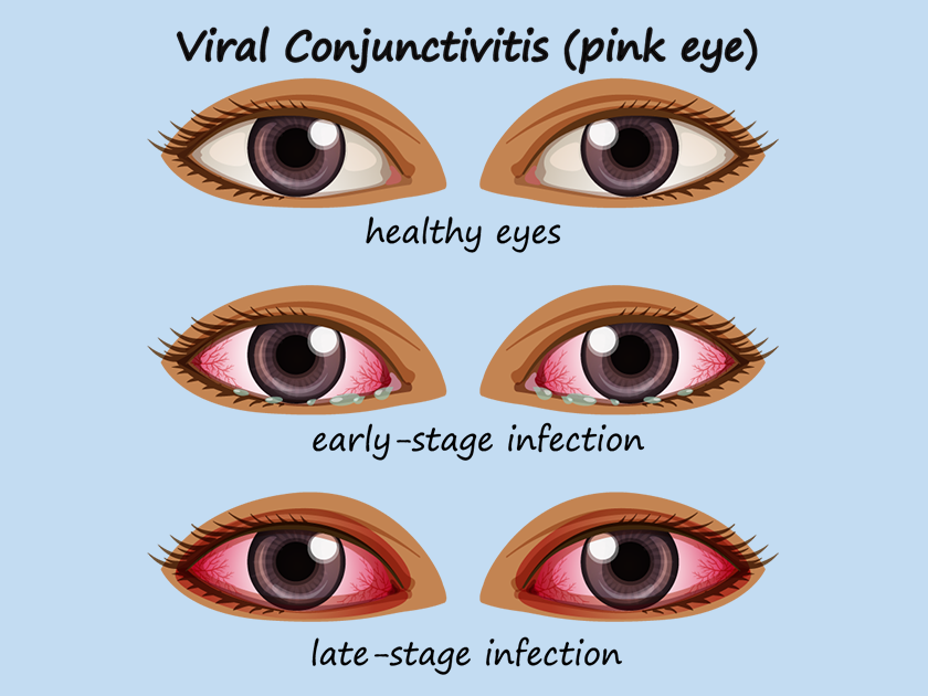 Pink Eye Infection Symptoms And Treatment Pakistan