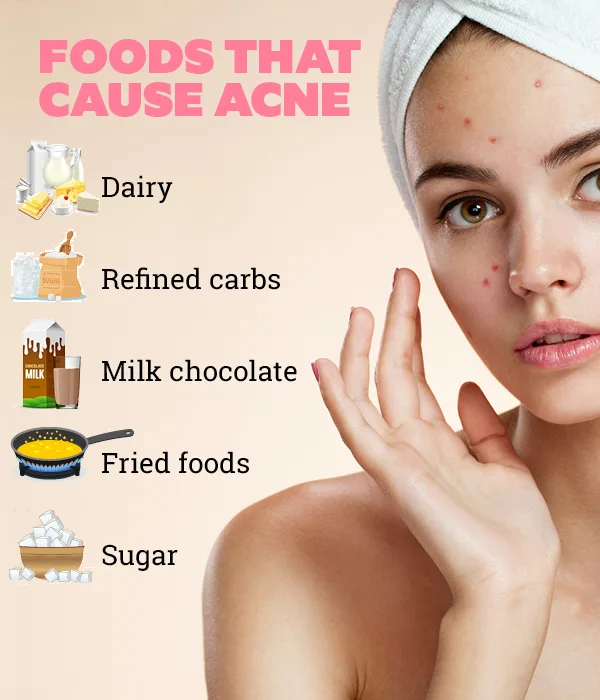 Acne Guide 101: Types, Causes, Treatment, Home Remedies, Skin Care