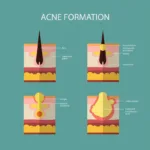 Acne formation