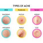 Types of Acne