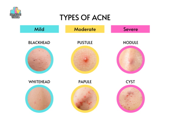 Types of Acne | Causes, Treatment, and Pictures