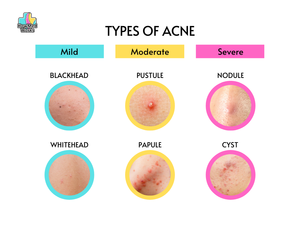 Types Of Acne Causes Treatment And Pictures