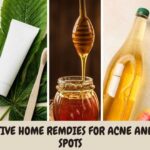 Home remedies for acne